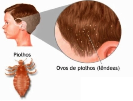 piolho5