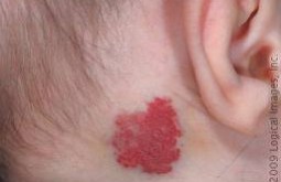 hemangioma1