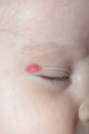 hemangioma2