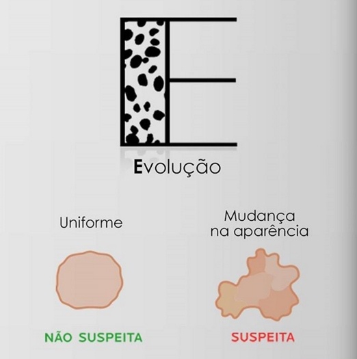 Descrição de pintas suspeitas quanto à evolução.