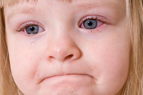 Saiba tudo sobre o surto de conjuntivite! - por Dr. Jairo Len - Just Real Moms
