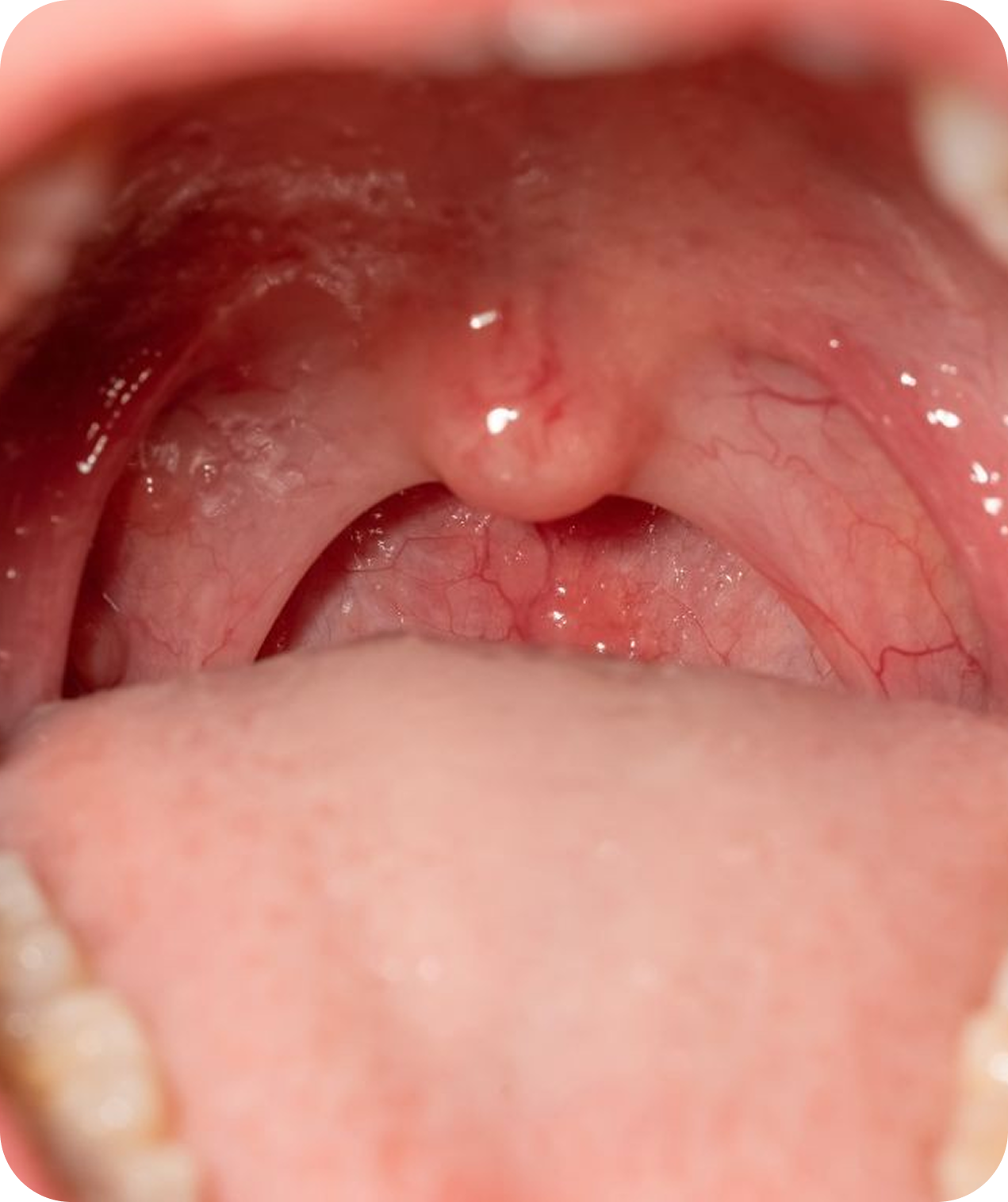 Cirurgia de Amígdalas